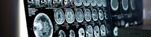 Read more about the article Hypnotherapy for Chronic Pain Relief, What Does the Science Say?